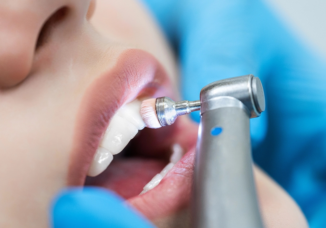 Nahaufnahme von Mund und Zähnen und einem zahnmedizinischen Gerät mit dem die Zähne professionell gereinigt werden.