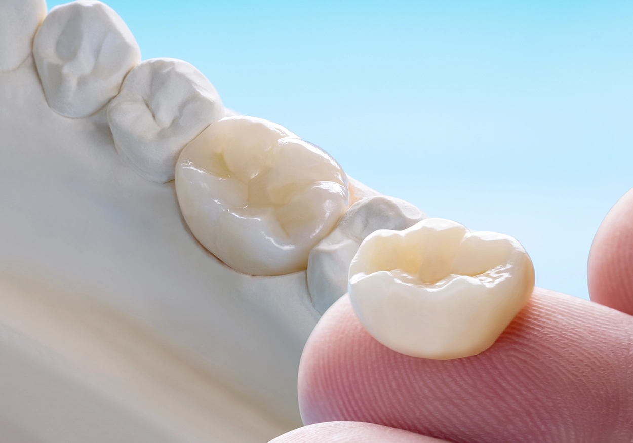 Eine Nahaufnahme von einem Gipsmodell mit Zähnen und einen Finger auf dem eine Zahnkrone liegt.